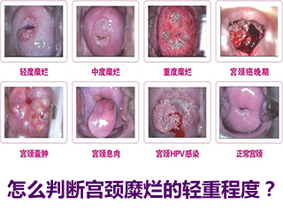 宫颈糜烂